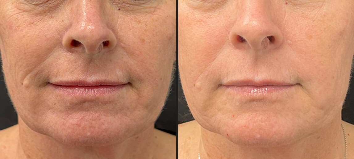 Solaria CO₂ laser fine lines and texture before and after — Hello Gorgeous Med Spa Oswego IL