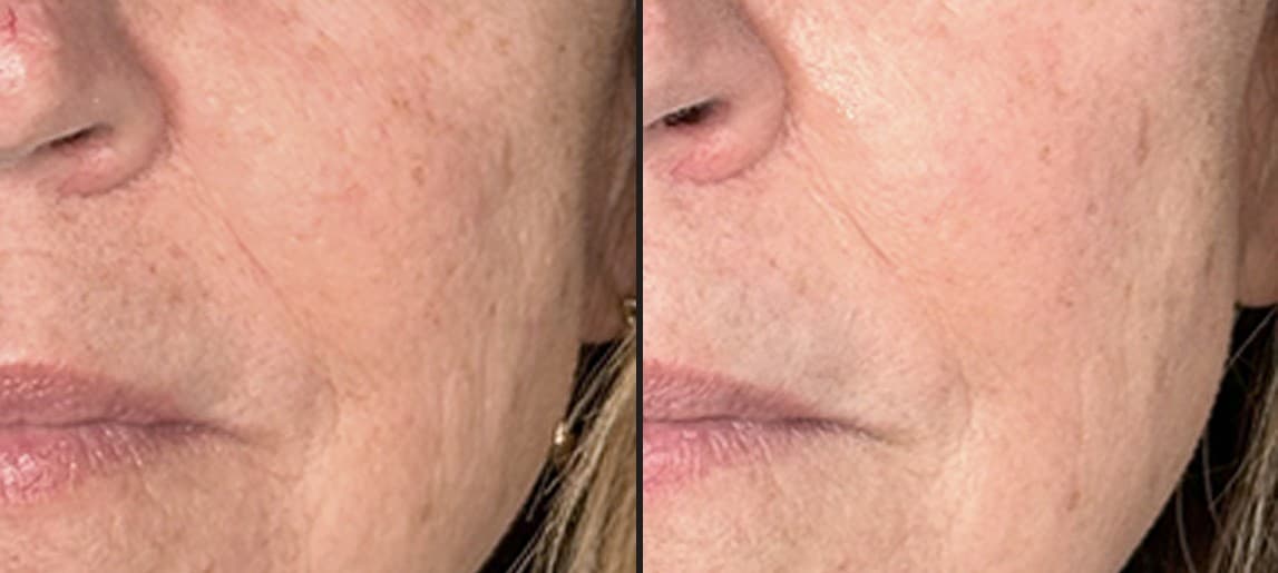 Solaria CO₂ laser wrinkles and skin laxity before and after — Hello Gorgeous Med Spa Oswego IL