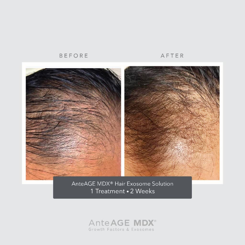AnteAGE MDX Hair Exosome Solution before and after — 1 treatment, 2 weeks