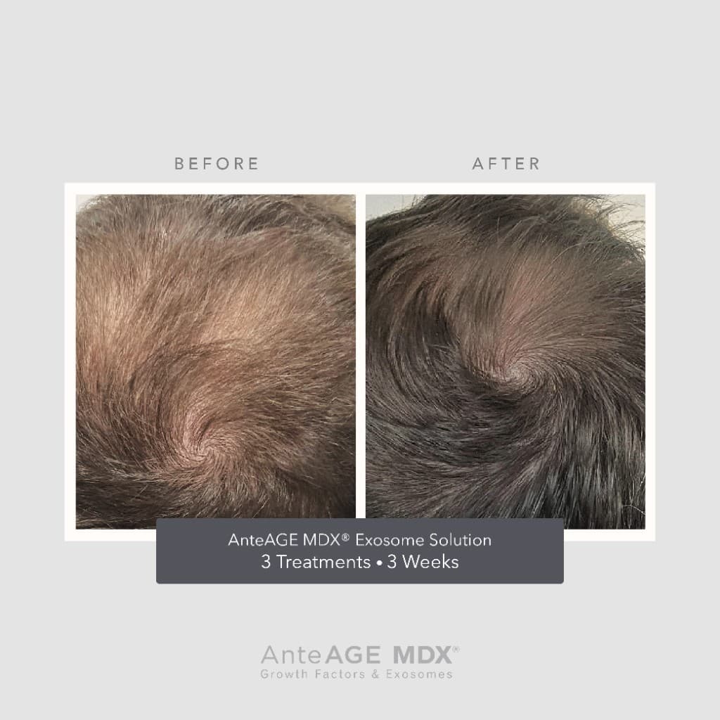 AnteAGE MDX Exosome Solution before and after crown — 3 treatments, 3 weeks
