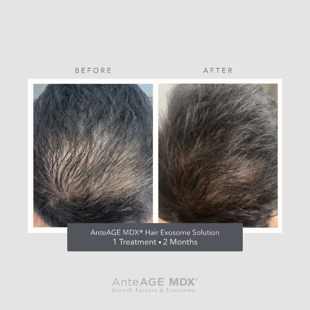 AnteAGE MDX Hair Exosome Solution crown before and after — 1 treatment, 2 months