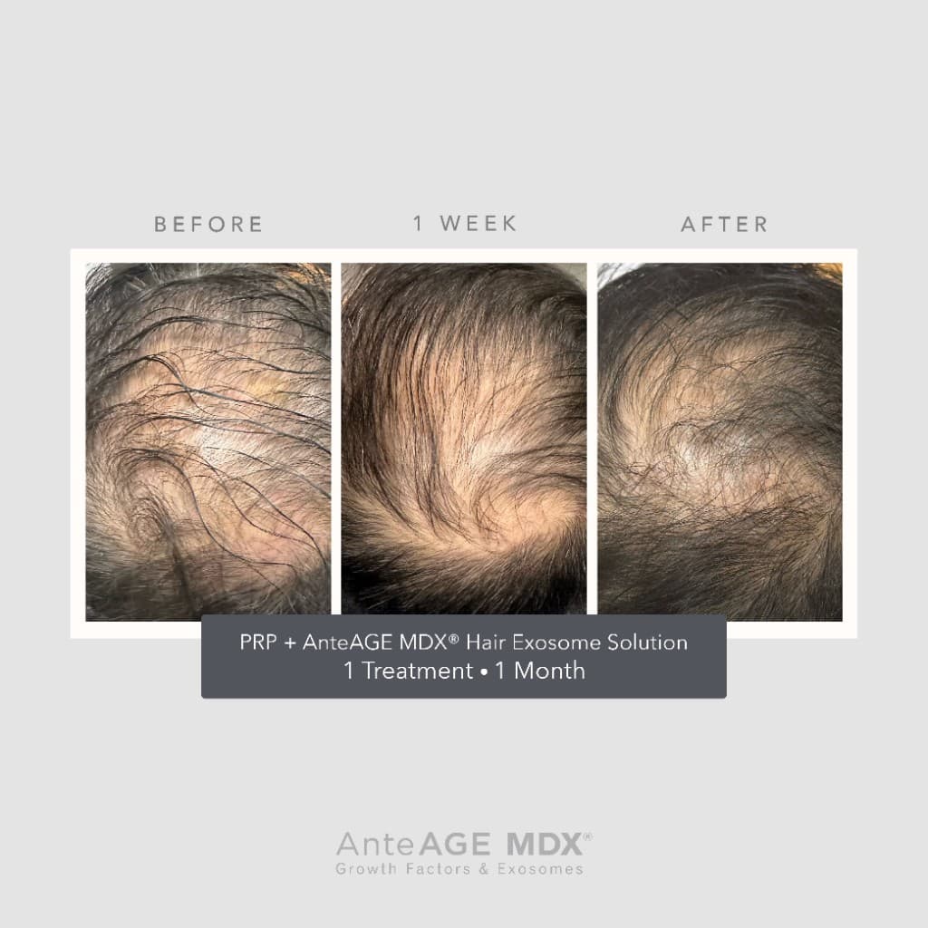 PRP plus AnteAGE MDX Hair Exosome Solution before, 1 week, and after — 1 treatment, 1 month