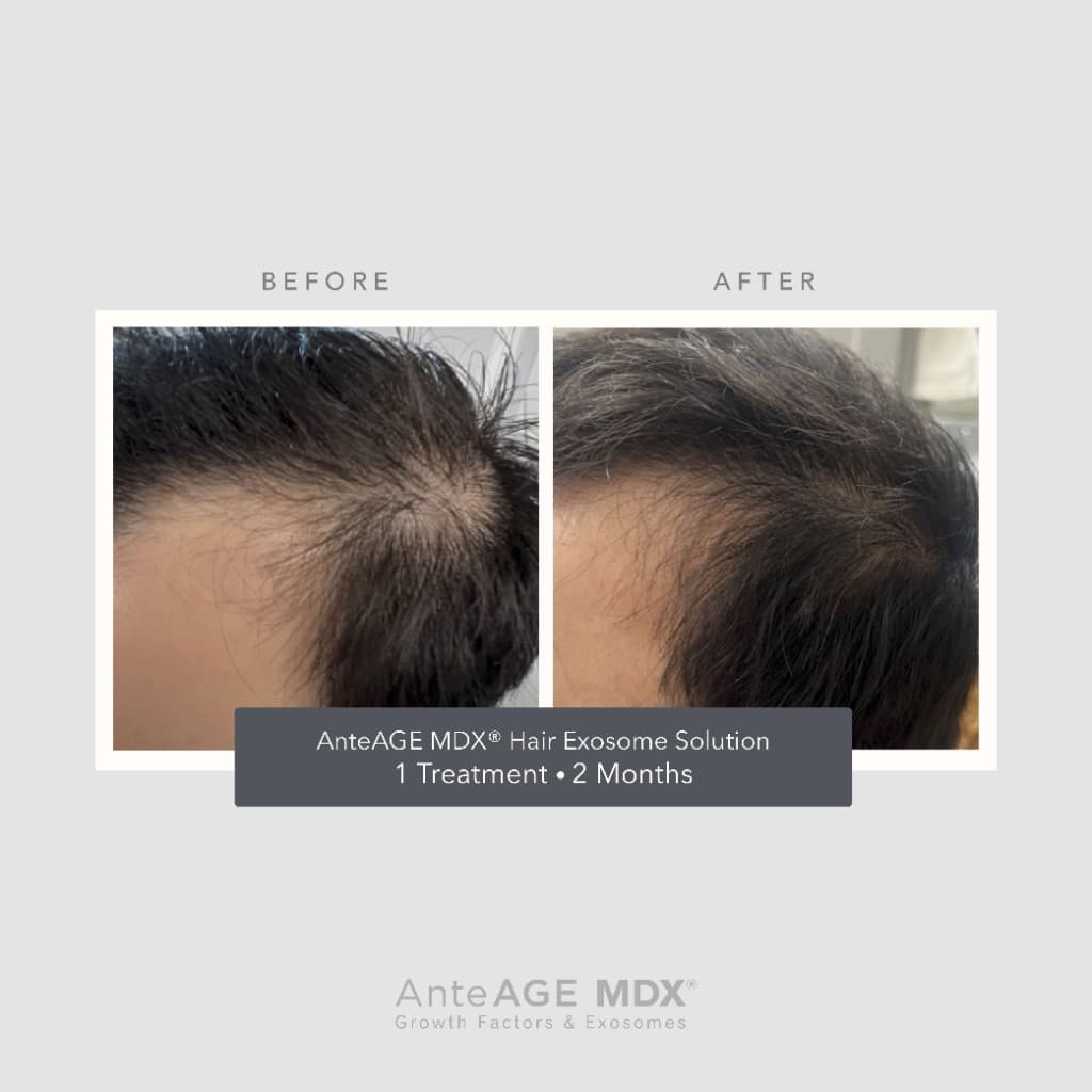 AnteAGE MDX Hair Exosome Solution temple before and after — 1 treatment, 2 months