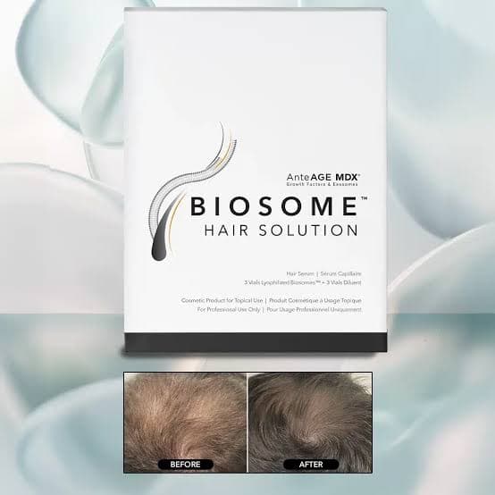 AnteAGE MDX Biosome Hair Solution with before and after scalp density — regenerative protocol at Hello Gorgeous Med Spa Oswego