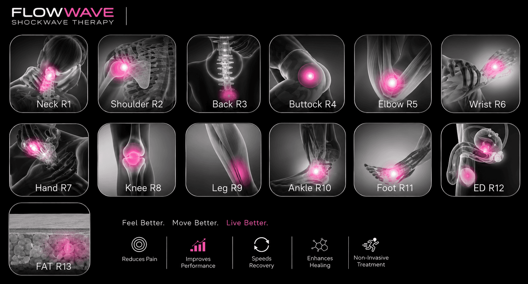 Treatment zones for FlowWave shockwave therapy