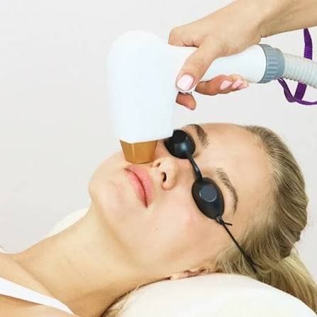 Lumecca IPL Photofacial treatment in Oswego IL at Hello Gorgeous Med Spa