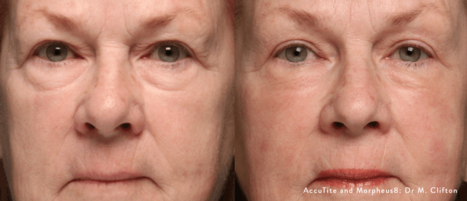 AccuTite before and after - eyelid and under eye tightening
