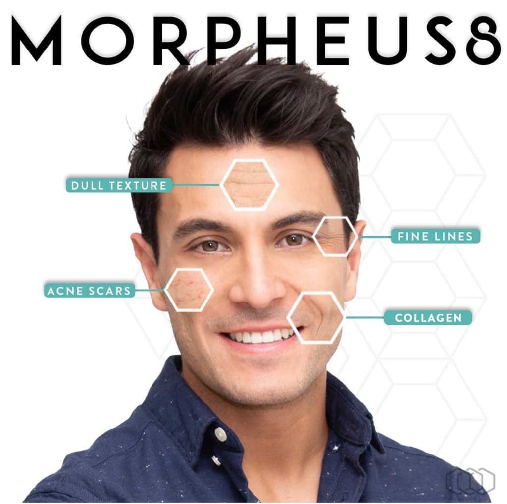 Morpheus8 treats dull texture, fine lines, acne scars, and collagen loss