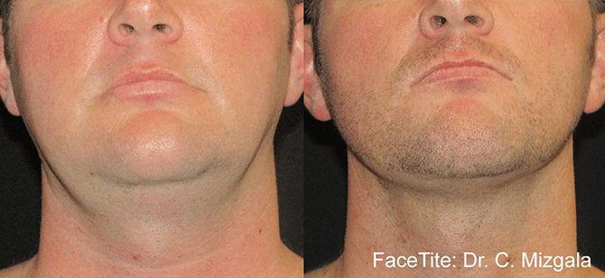 Quantum RF chin and neck treatment results