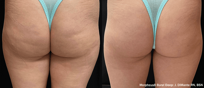 Morpheus8 Burst Deep before and after - buttocks cellulite reduction