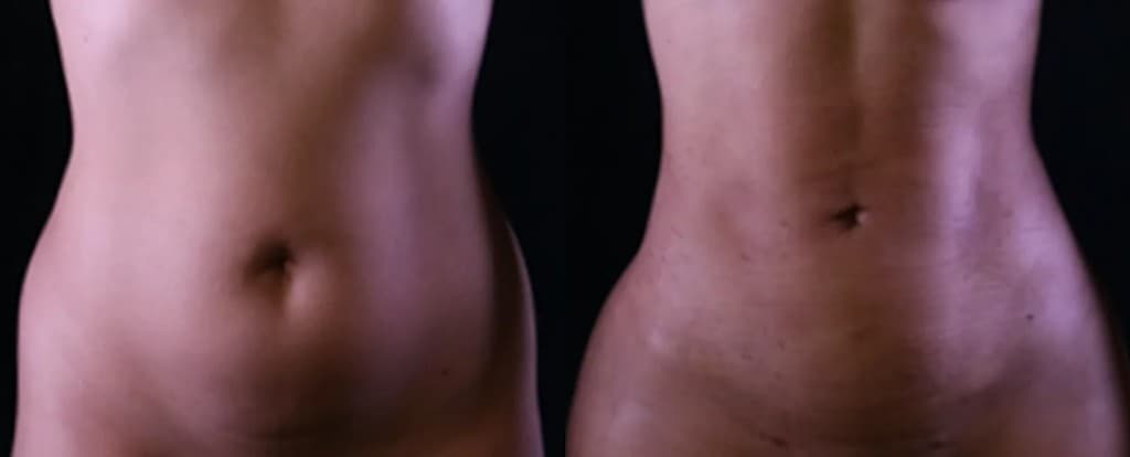 Quantum RF abdomen treatment