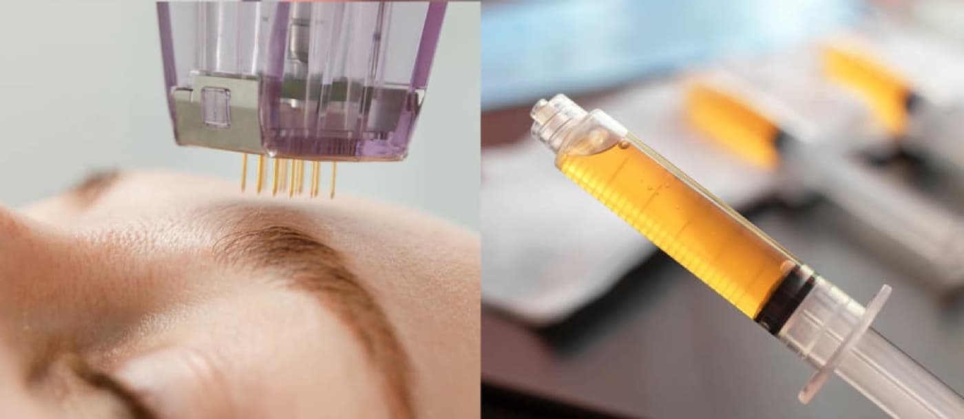 PRP microneedling treatment — pen device and golden platelet-rich plasma syringe