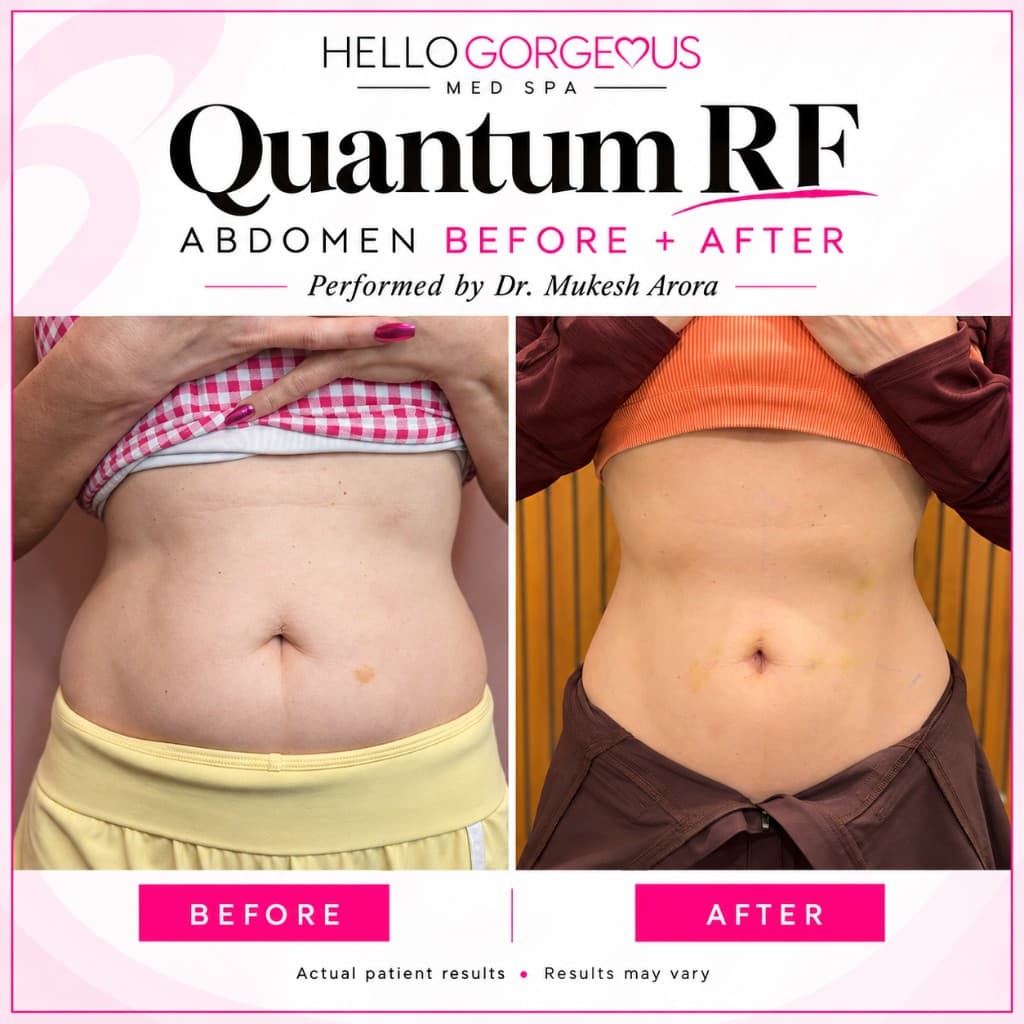Hello Gorgeous patient abdomen photography after body contouring consultation and treatment in Oswego