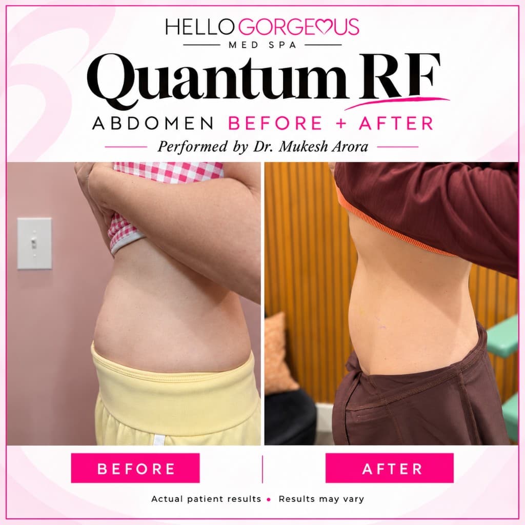 Side-view abdomen photography from a Hello Gorgeous Med Spa body contouring patient