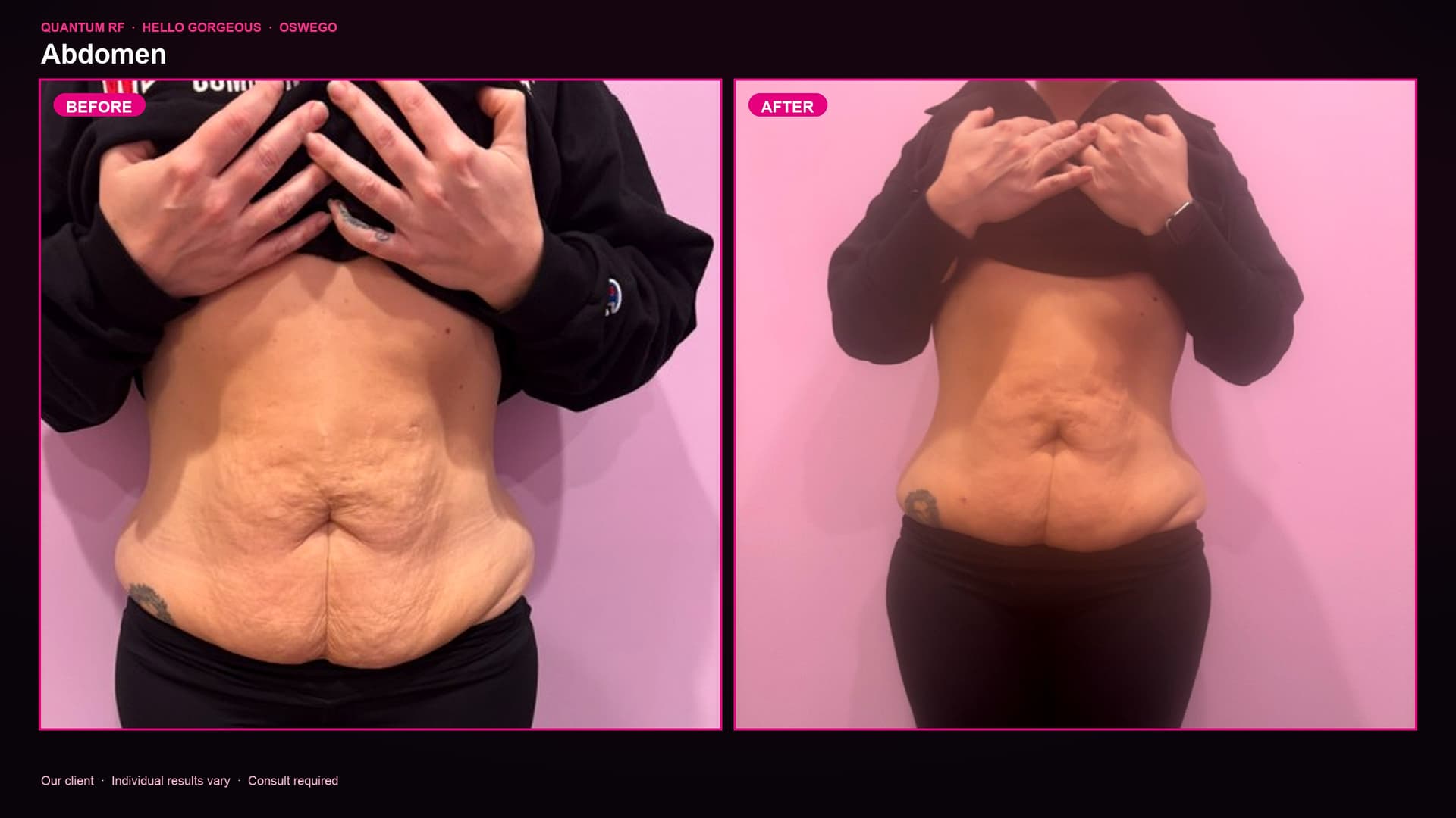 Quantum RF abdomen before and after — Hello Gorgeous Med Spa client, Oswego