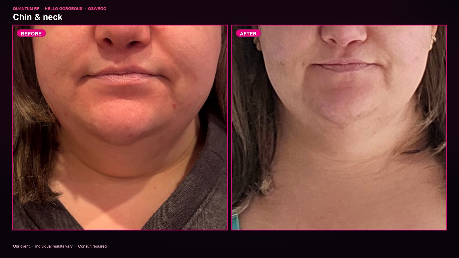 Quantum RF chin and neck before and after — Hello Gorgeous Med Spa client, Oswego