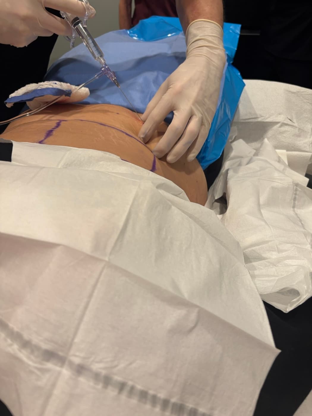 Quantum RF body contouring treatment in progress at Hello Gorgeous Med Spa in Oswego, IL